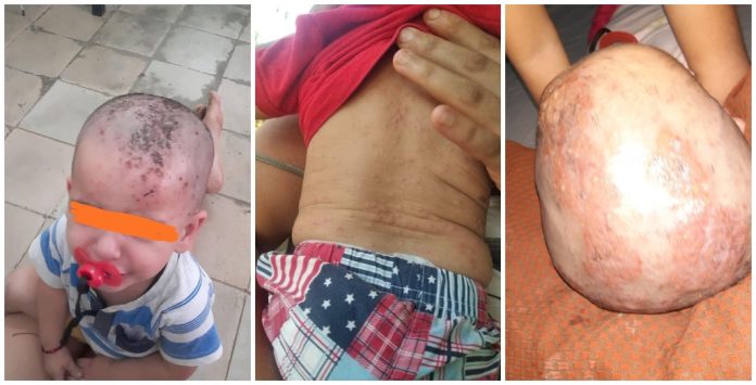 La sarna en Cuba sigue propagándose y se ceba con los bebés